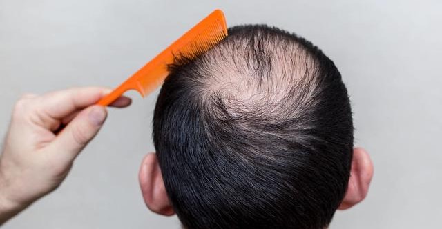 5 Causes Of Baldness In Males