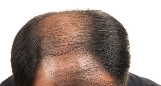 5 Causes Of Baldness In Males 3