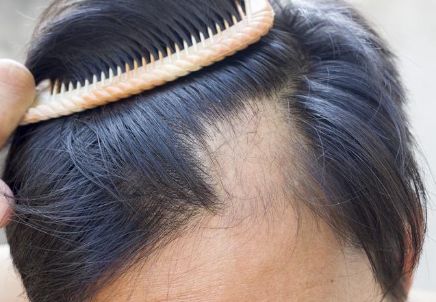 8 Causes Of Hair Loss 10