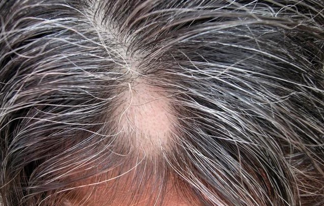 8 Causes Of Hair Loss 14