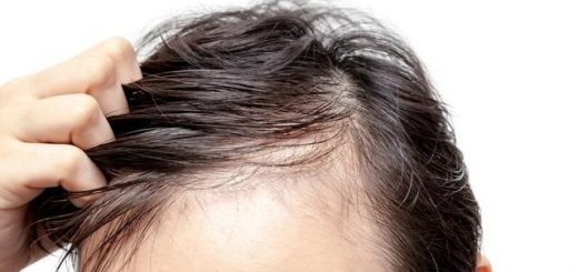 8 Causes Of Hair Loss 2