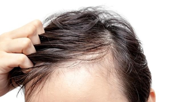 8 Causes Of Hair Loss 2