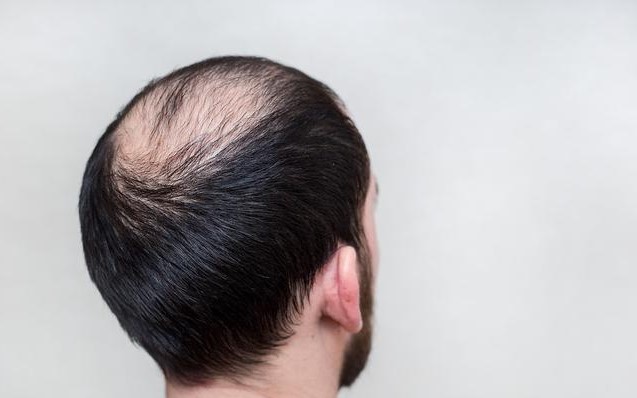 8 Causes Of Hair Loss 3
