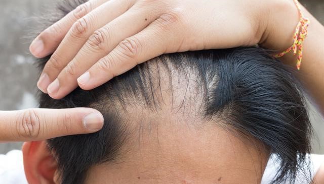 Frequent Hair Loss May Be Caused By 6 Diseases 2