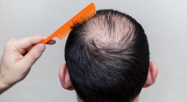 Frequent Hair Loss You May Lack 6 Nutrition 2