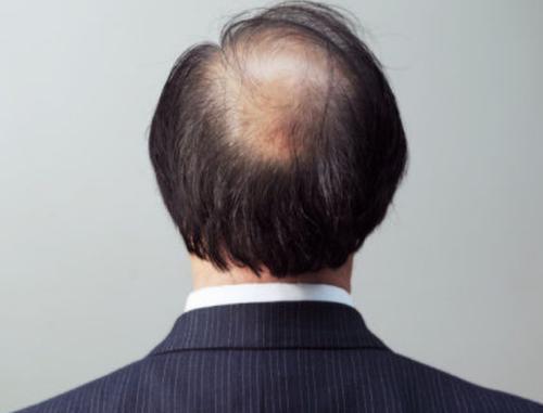 How To Deal With The Serious Problem Of Hair Loss 2