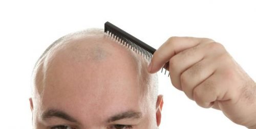 Watch Out For Baldness In Men 3 Points To Treat Hair Loss Are Important 1